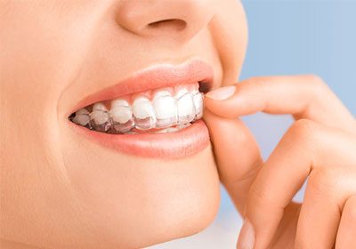 Invisalign-use Invisalign-use